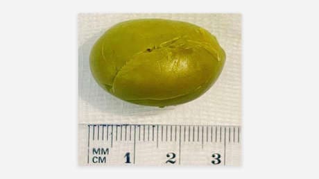 Médicos rusos logran extraer con éxito una aceituna del estómago de un menor; advierten por riesgos de obstrucción